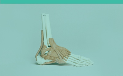 Cause and treatment of plantar fasciitis