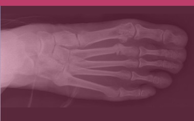 How do you detect a stress fracture?